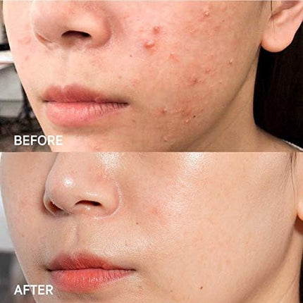 SOME BY MI AHA BHA PHA 14 Days Super Miracle Spot All Kill Cream 30ml